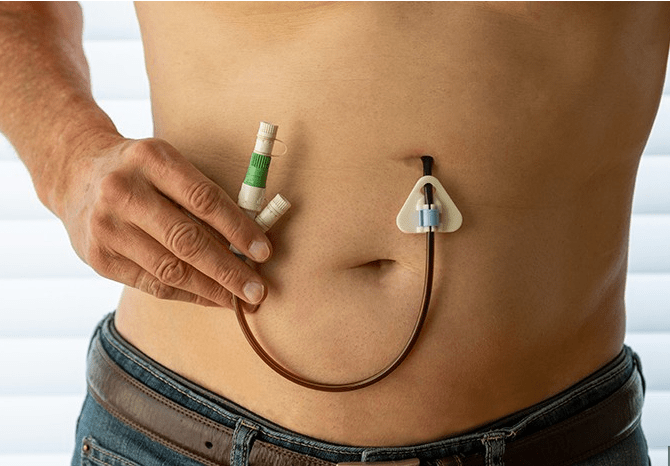 Can’t Swallow? Welcome to the World of Enteral&nbsp;Feeding